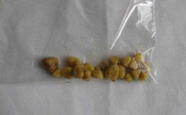 腎結(jié)石該如何藥物治療？腎結(jié)石有哪些危害？(1)