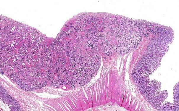 直腸癌有哪些病因？直腸癌有何治療方法？(3)