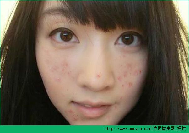 18歲臉上長了青春痘怎么辦？青春痘怎么治療？(2)