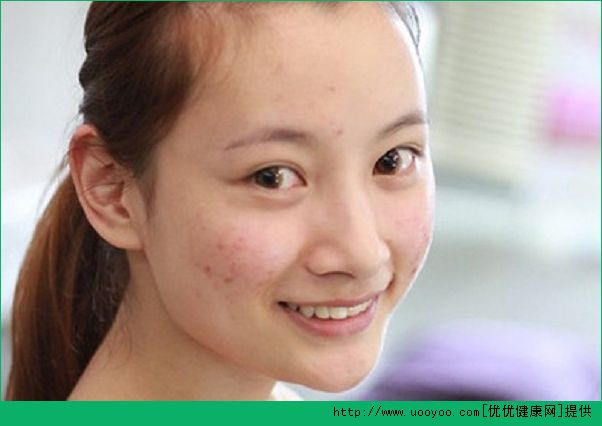 18歲臉上長了青春痘怎么辦？青春痘怎么治療？(3)