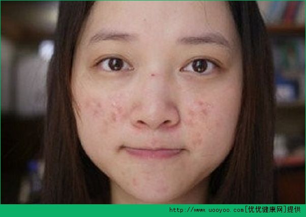 18歲臉上長了青春痘怎么辦？青春痘怎么治療？(4)