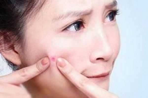 高中生臉上長痘怎么辦？高中生如何快速祛痘？(1)