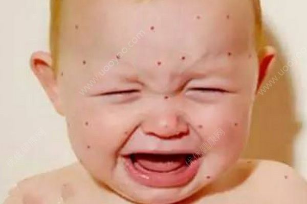 如何預(yù)防水痘傳染？高中生怎么預(yù)防水痘？(2)