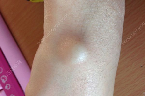 我手腕上長個包怎么回事？我手腕上長了個疙瘩(1)