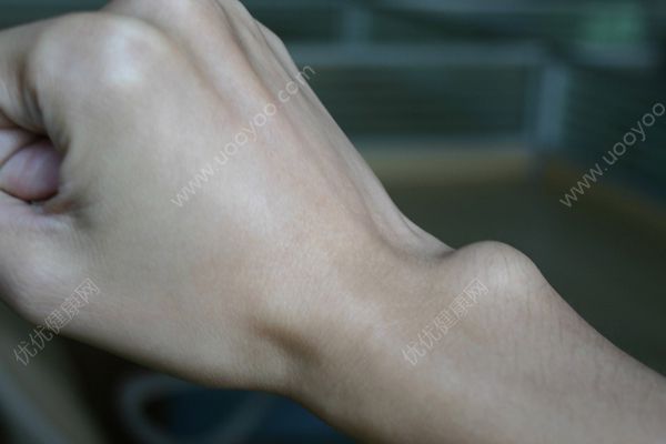 我手腕上長個包怎么回事？我手腕上長了個疙瘩(2)