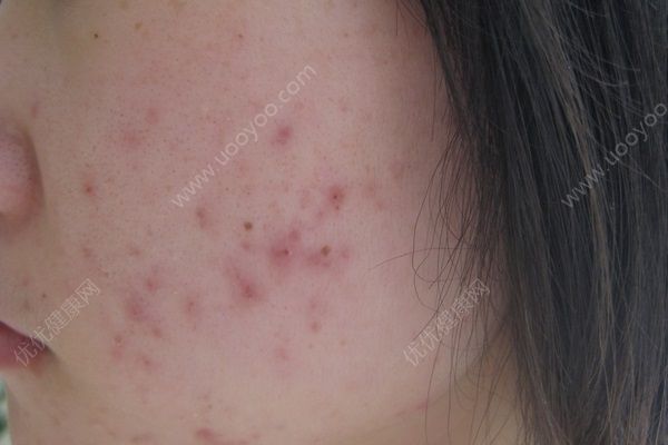 為什么我會長痘痘？為什么我長痘會留黑??？(1)