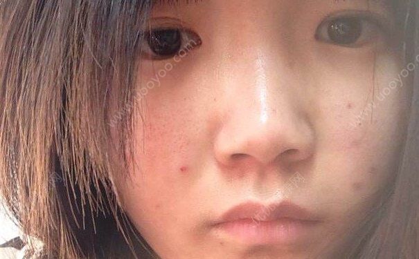 長(zhǎng)青春痘怎么消除？青春痘怎么去除？(1)