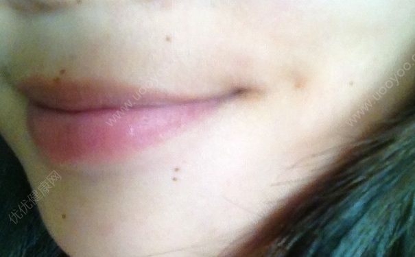 初中女生可以點(diǎn)痣嗎？點(diǎn)痣后要注意什么？(2)