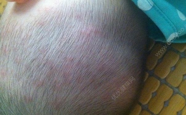 寶寶長痱子怎么辦？如何預(yù)防寶寶長痱子？(4)