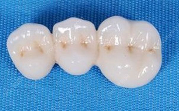 烤瓷牙怎么取下來？烤瓷牙如何拆除？(1)