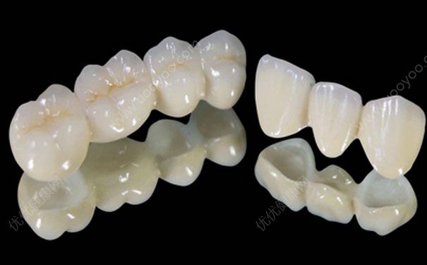 烤瓷牙和全瓷牙區(qū)別有哪些？全瓷牙和烤瓷牙哪個好？(1)