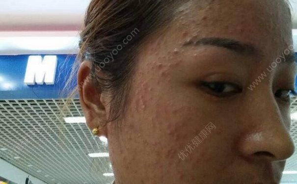 臉上長白頭粉刺怎么辦？臉上長白頭粉刺怎么去除？(1)