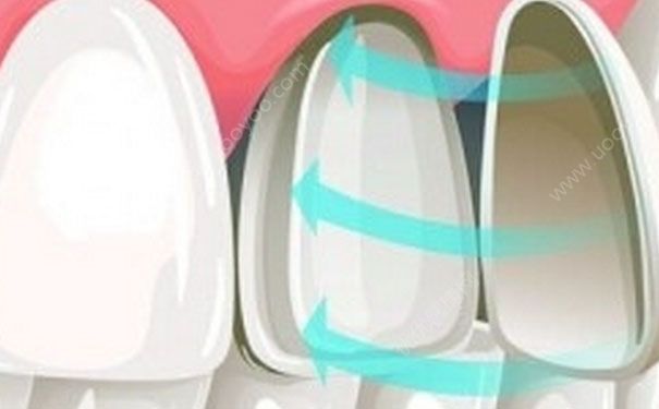 牙齒貼面可以維持多久？牙齒貼面能用多久？(1)