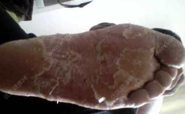 腳干燥脫皮怎么辦？腳特別干還脫皮怎么辦？(1)