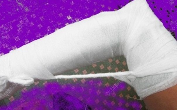 骨折需要做手術(shù)嗎？骨折一定要做手術(shù)嗎？(1)