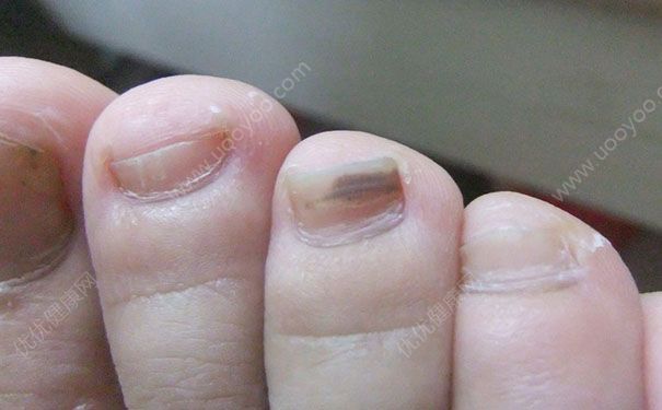 打球腳趾甲淤血怎么辦？打球腳指甲黑了怎么辦？(1)