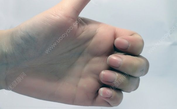 指甲有黑色豎紋是怎么回事？指甲上有黑色豎紋是怎么回事？(1)