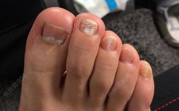 腳趾甲里面有白色粉末是怎么回事？腳趾甲里有白色粉末怎么辦？(1)