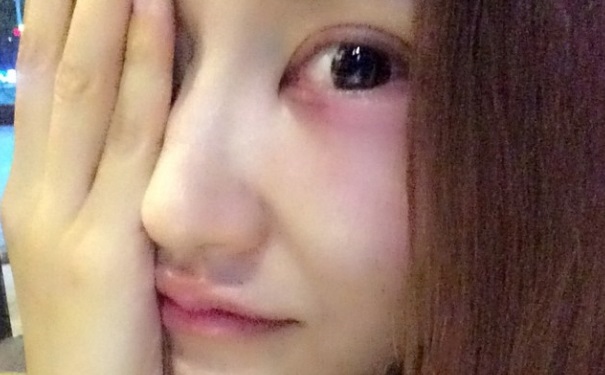 熬夜眼睛腫了怎么辦才能消腫？經(jīng)常熬夜眼睛腫怎么辦？(1)