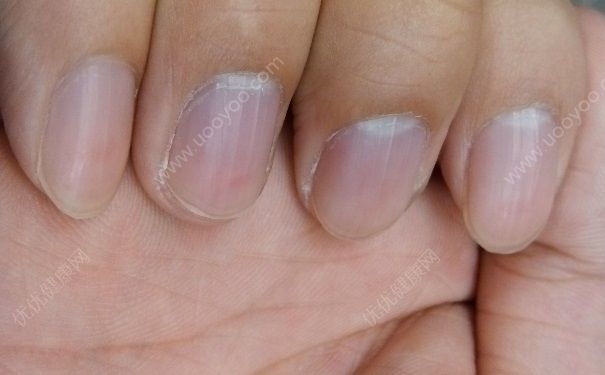 指甲長(zhǎng)有黑色豎紋是什么？指甲長(zhǎng)有黑色豎紋是怎么回事？(1)
