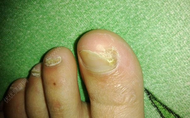 腳趾甲變厚發(fā)黃怎么回事？腳趾甲變厚是什么原因？(1)