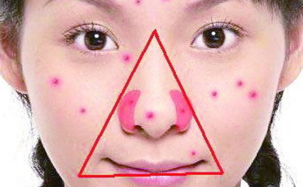 三角區(qū)的痘痘為什么不能擠？三角區(qū)長(zhǎng)痘痘不能擠原因？(1)