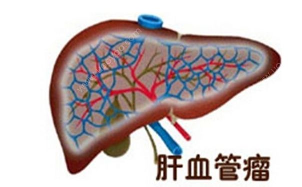 肝血管瘤嚴(yán)重嗎？肝血管瘤的癥狀表現(xiàn)(1)