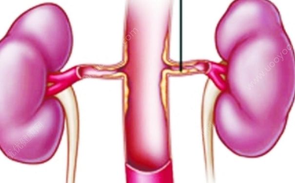 腎積水怎么治療？腎積水的治療應如何治療？(1)