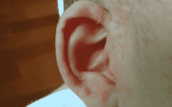 耳屎多該怎么辦？耳屎多該怎么清理？(1)