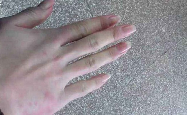 凍瘡要怎么治療？治療凍瘡要注意什么？(1)