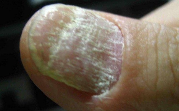 灰指甲要如何治療？灰指甲的病因有哪些？(1)