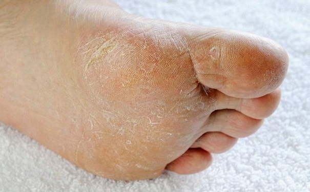 腳氣病有哪些原因？腳氣病要怎么預(yù)防？(1)