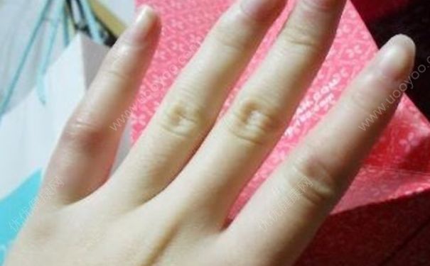 冬季皮膚怎么預(yù)防凍瘡？冬季要怎么避免被凍傷了？(2)