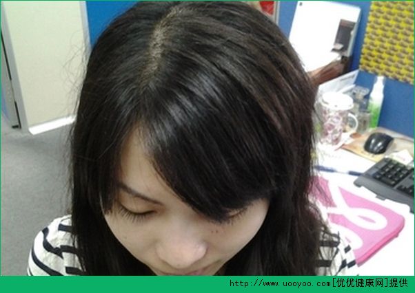 我14歲為什么老是掉頭發(fā)？14歲老是掉頭發(fā)該怎么辦？(2)