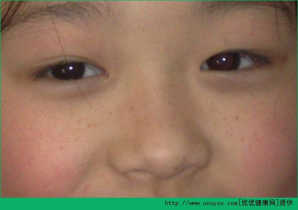 17歲臉上長斑的原因？17歲臉上有斑怎么辦？(1)