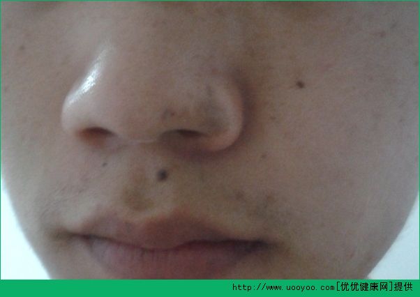 17歲臉上長斑的原因？17歲臉上有斑怎么辦？(2)