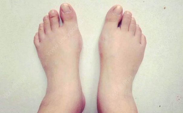腳水腫是怎么回事？腳水腫了怎么辦？(1)
