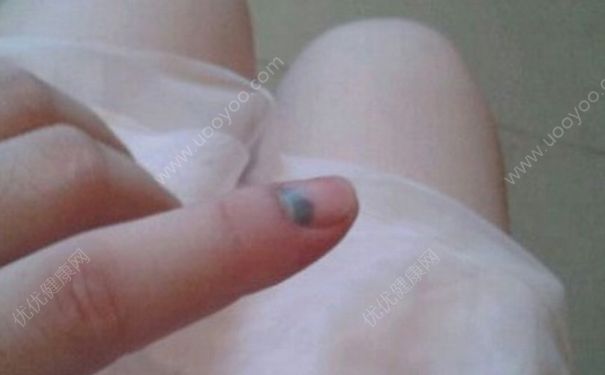 手被門夾了怎么辦？手被門夾了如何止痛？(2)
