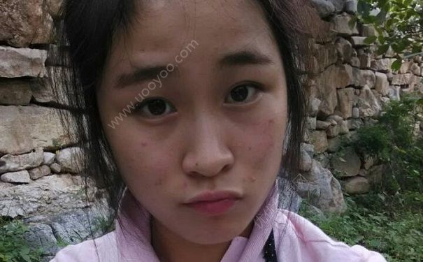 天熱起痘痘怎么回事？天熱長(zhǎng)痘痘怎么辦？(1)