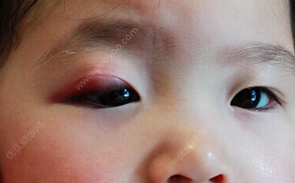 上眼皮腫了是怎么回事？上眼皮紅腫癢是怎么回事？(1)