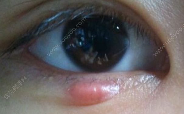 上眼皮腫了是怎么回事？上眼皮紅腫癢是怎么回事？(3)