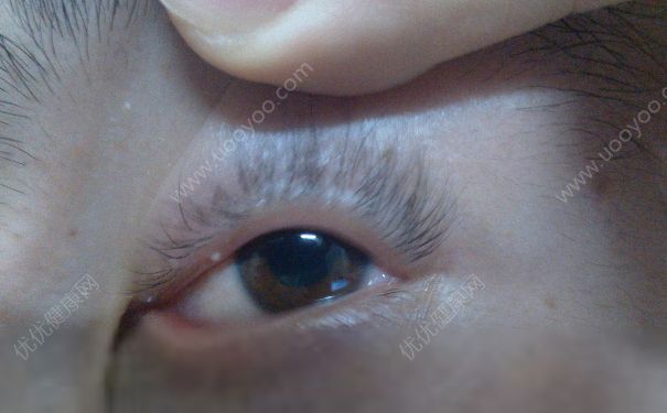 上眼皮腫了是怎么回事？上眼皮紅腫癢是怎么回事？(4)