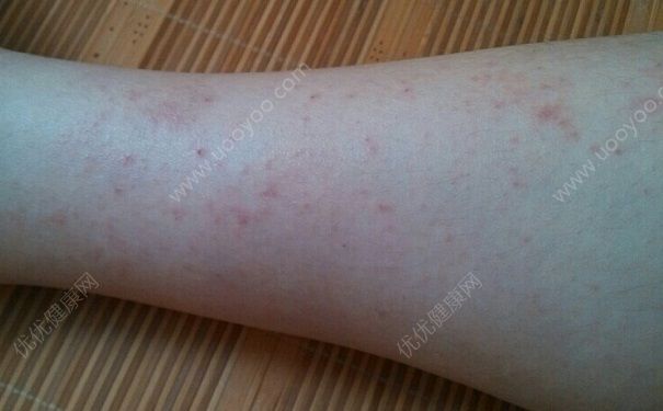 天熱了臉上就會癢是什么原因？天熱臉上很癢怎么辦？(3)