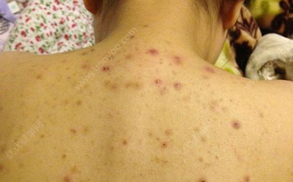 天熱背上起紅疙瘩怎么回事？天熱背上起小紅點(diǎn)怎么辦？(1)