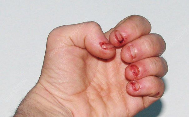 咬指甲對手指有影響嗎？咬指甲對手指的危害(3)