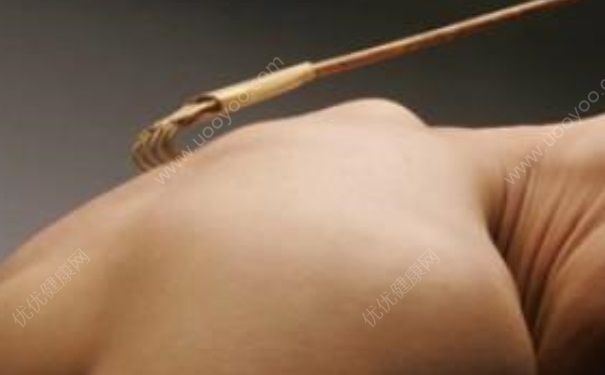 耳朵濕疹是怎么引起的？耳朵后面有濕疹怎么辦？(2)