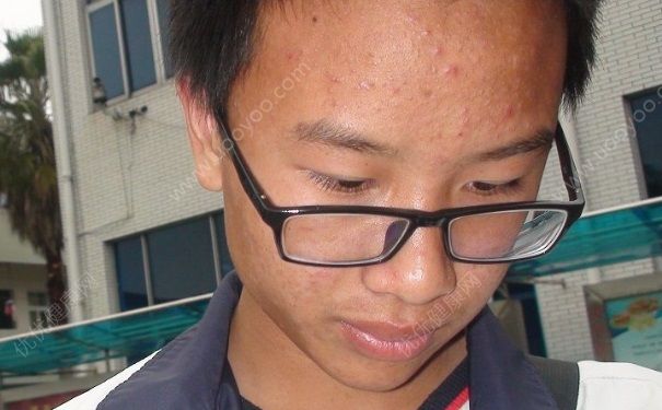 閉口粉刺是什么？閉口粉刺怎么去除？(2)