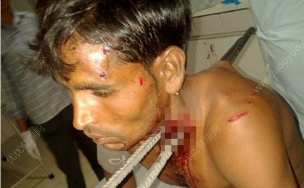 男子被竹竿穿頸 脖子被捅穿了還能活嗎？(2)