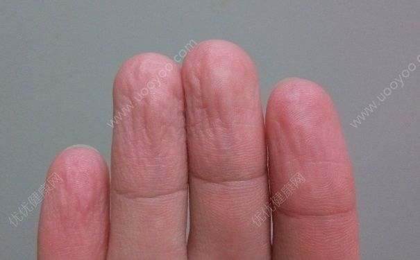 手泡水里為什么會皺？手泡水后發(fā)白起皺怎么辦？(1)
