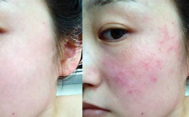 激素臉怎么治？激素臉怎么調(diào)理？(1)